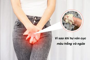 Vùng kín bị ngứa và có dịch trắng vón cục : Nguyên nhân + Cách chữa trị