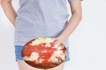 Cách chữa nấm Candida ở vùng kín hiệu quả, an toàn, ít tái phát, chi phí hợp lý