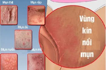 [Tổng hợp] Hình ảnh nổi mụn ở vùng kín nữ thường gặp